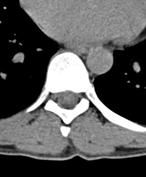 File:Aneurysmal bone cyst T11 (Radiopaedia 29294-29721 Axial non-contrast 17).jpg