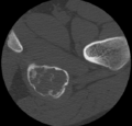 Aneurysmal bone cyst of ischium (Radiopaedia 25957-26094 B 37).png