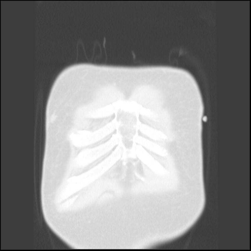 Angioinvasive aspergillosis (Radiopaedia 43957-47466 Coronal lung window 89).jpg