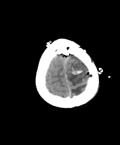File:Angiomatous meningioma (Radiopaedia 79459-92578 Axial non-contrast 27).jpg