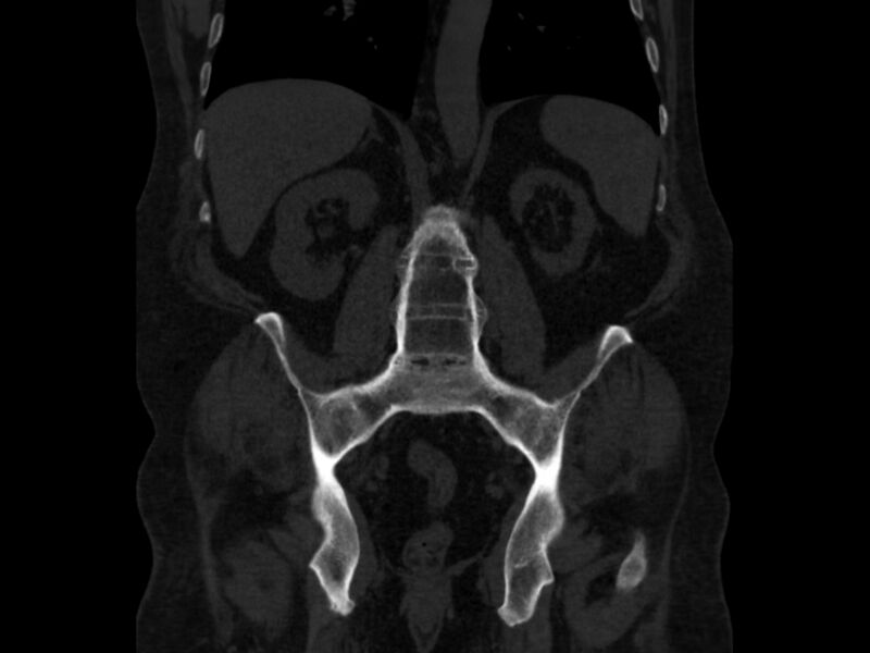 File:Ankylosing spondylitis (Radiopaedia 44609-48357 Coronal bone window 53).jpg