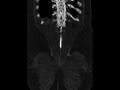 Ankylosing spondylitis (Radiopaedia 44609-48357 Coronal bone window 96).jpg