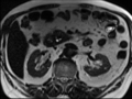 Annular pancreas (Radiopaedia 38292-40320 B 19).png