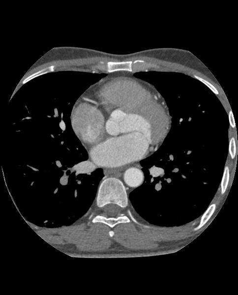 File:Anomalous coronary arteries (Radiopaedia 83979-99206 A 163).jpg