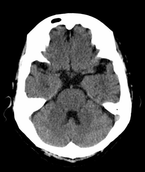 File:Anomalous intracranial venous drainage (Radiopaedia 28161-28418 Axial 39).png