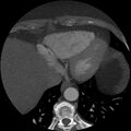 Anomalous origin of left circumflex artery from right coronary sinus (Radiopaedia 72563-83117 A 10).jpg