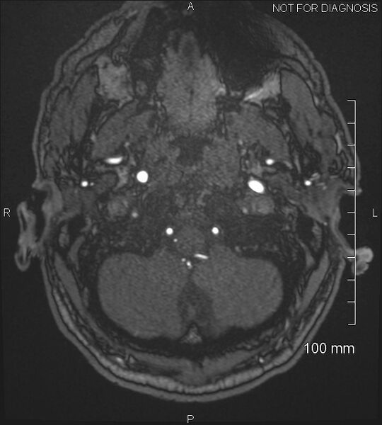 File:Anterior cerebral artery aneurysm (Radiopaedia 80683-94127 Axial MRA 13).jpg