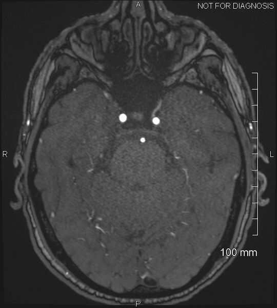 File:Anterior cerebral artery aneurysm (Radiopaedia 80683-94127 Axial MRA 74).jpg