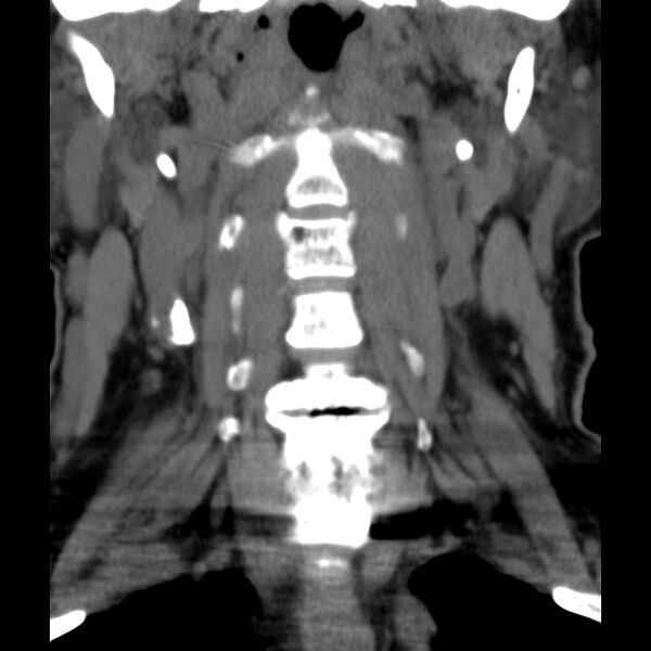 File:Anterior cervical postdiscectomy arthrodesis (Radiopaedia 32678-33646 Coronal non-contrast 8).jpg