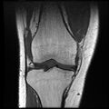 Anterior cruciate ligament tear with posteromedial corner injury, bucket-handle meniscal tear and chondral delamination (Radiopaedia 75501-86744 Coronal T1 11).jpg