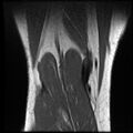 Anterior cruciate ligament tear with posteromedial corner injury, bucket-handle meniscal tear and chondral delamination (Radiopaedia 75501-86744 Coronal T1 24).jpg