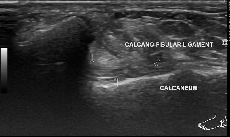 File:Anterior inferior tibiofibular ligament injury (Radiopaedia 65077-74073 Longitudinal 5).jpg