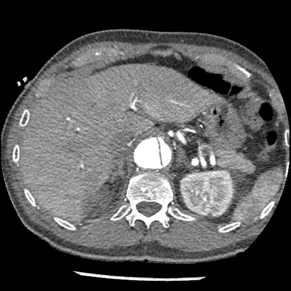 File:Aortic dissection - DeBakey Type I-Stanford A (Radiopaedia 79863-93115 A 39).jpg