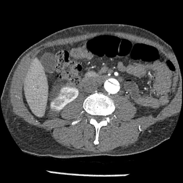 File:Aortic dissection - DeBakey Type I-Stanford A (Radiopaedia 79863-93115 A 56).jpg