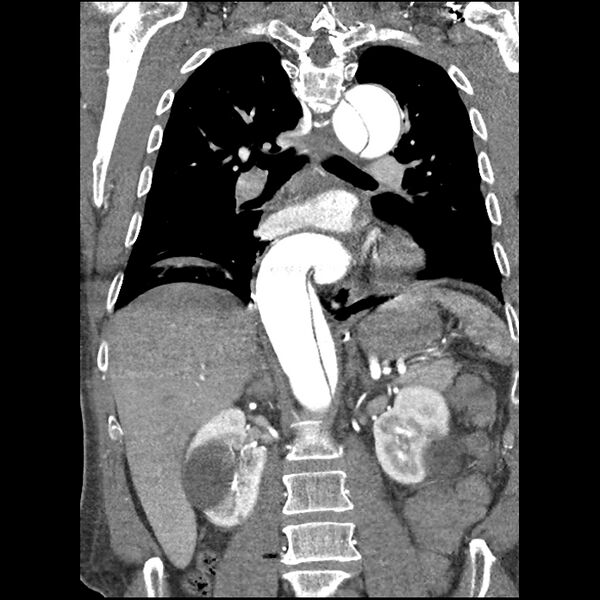 File:Aortic dissection - DeBakey Type I-Stanford A (Radiopaedia 79863-93115 B 23).jpg