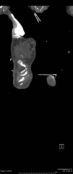 File:Aortic dissection with extension into aortic arch branches (Radiopaedia 64402-73204 A 1).jpg