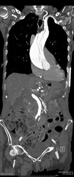 File:Aortic dissection with extension into aortic arch branches (Radiopaedia 64402-73204 A 27).jpg