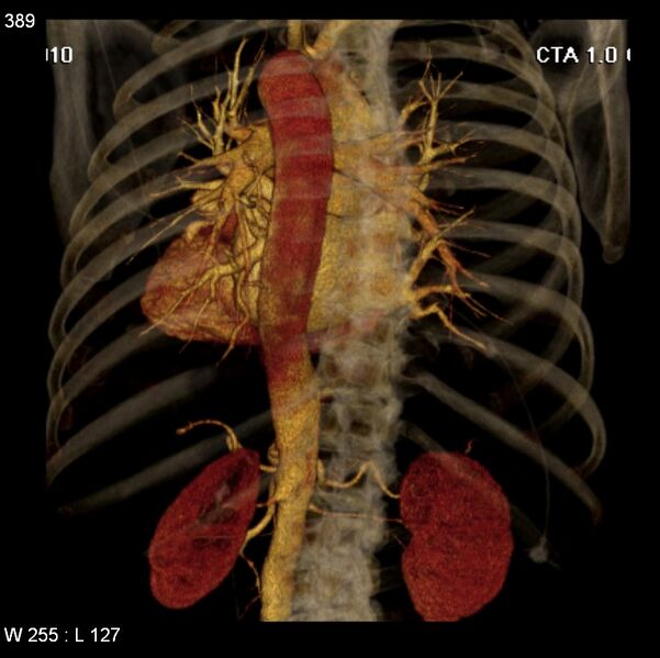 File:Aortic dissection with rupture into pericardium (Radiopaedia 12384-12647 C+ arterial phase 21).jpg