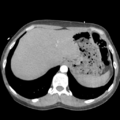 Aortic valve non-coronary cusp thrombus (Radiopaedia 55661-62189 B 46).png