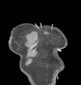 Aortic valve non-coronary cusp thrombus (Radiopaedia 55661-62189 C 6).png