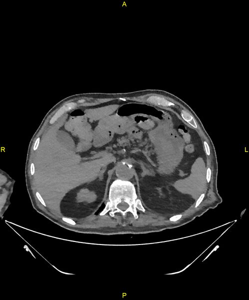 File:Aortoenteric fistula (Radiopaedia 84308-99603 Axial non-contrast 72).jpg