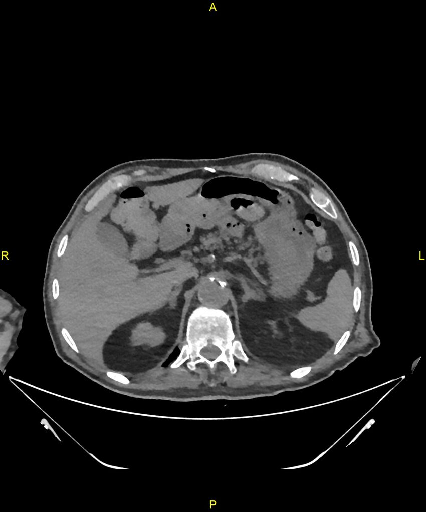 Aortoenteric fistula (Radiopaedia 84308-99603 Axial non-contrast 72).jpg