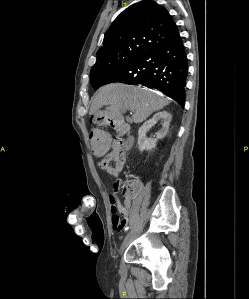 File:Aortoenteric fistula (Radiopaedia 84308-99603 C 109).jpg