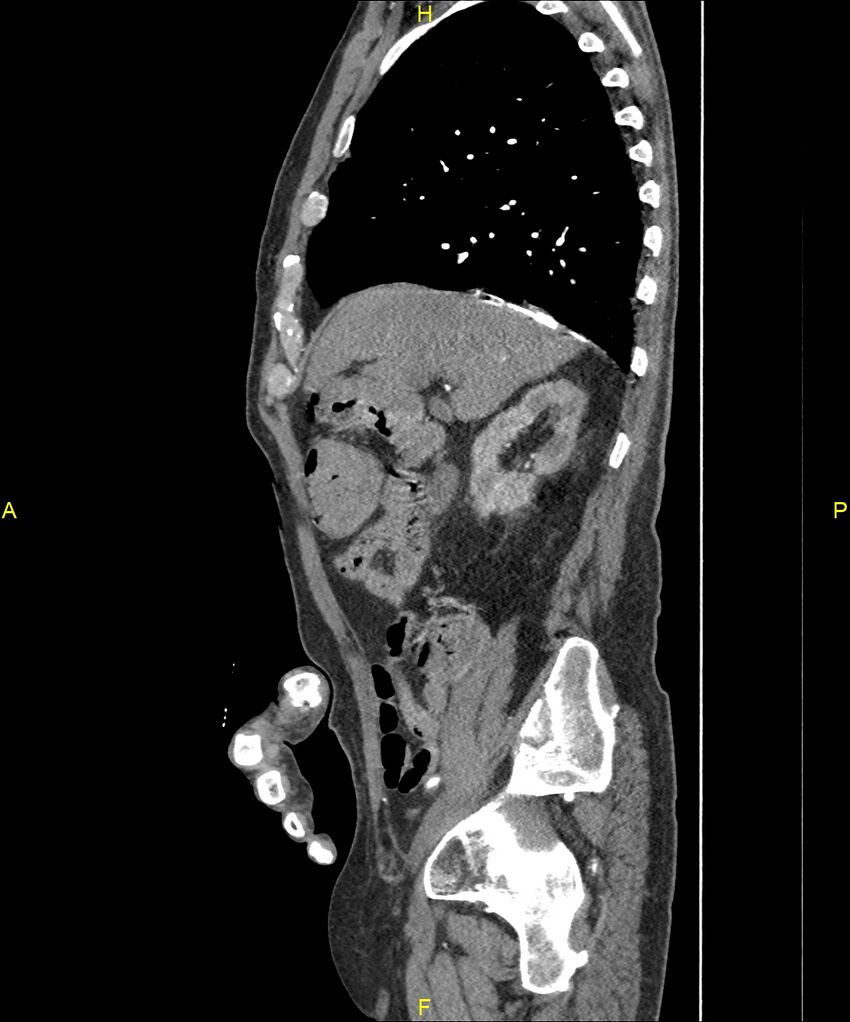 Aortoenteric fistula (Radiopaedia 84308-99603 C 109).jpg