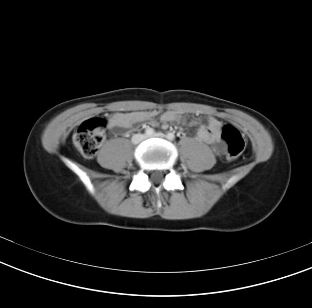 File:Appendicitis and incidental bicornuate uterus (Radiopaedia 22833-22853 B 28).jpg