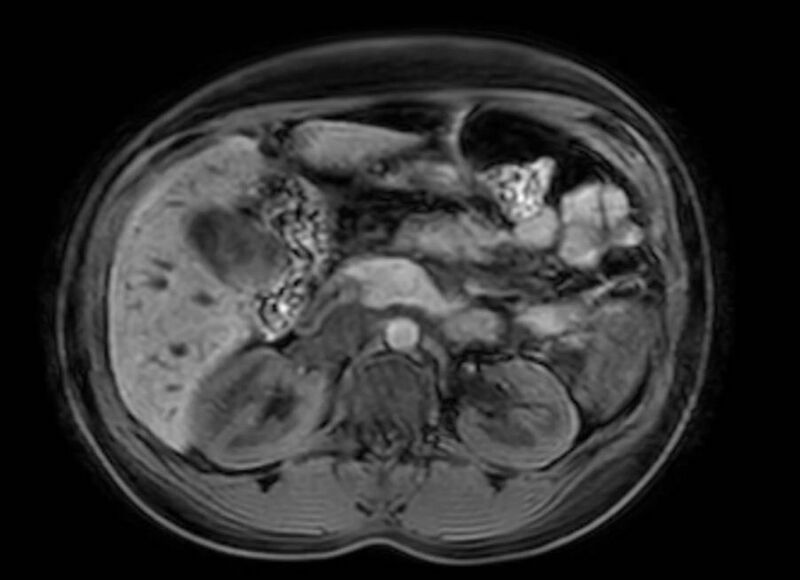 File:Appendicitis in gravida (MRI) (Radiopaedia 89433-106395 Axial DIXON 45).jpg