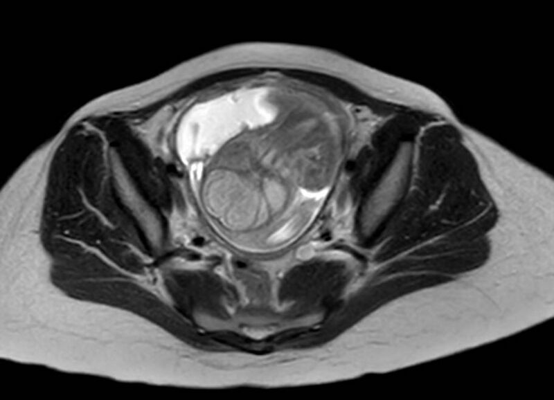 File:Appendicitis in gravida (MRI) (Radiopaedia 89433-106395 Axial T2 58).jpg