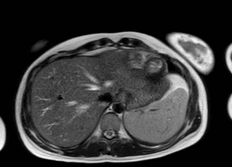File:Appendicitis in gravida (MRI) (Radiopaedia 89433-106395 Axial T2 6).jpg