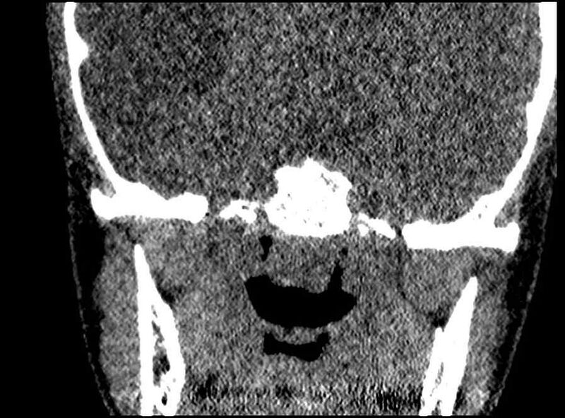 File:Arachnoid cyst- extremely large (Radiopaedia 68741-78450 Coronal bone window 6).jpg