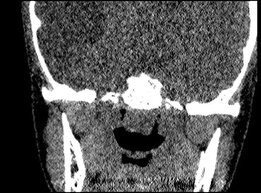Arachnoid cyst- extremely large (Radiopaedia 68741-78450 Coronal bone window 6).jpg