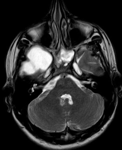 File:Arachnoid cyst- extremely large (Radiopaedia 68741-78451 Axial T2 7).jpg