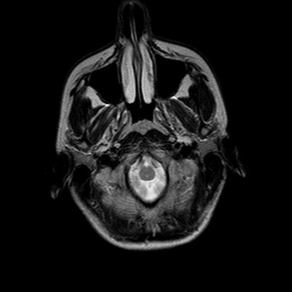 File:Arrested pneumatization of the sphenoid (Radiopaedia 10700-11173 Axial T2 2).jpg