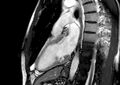 Arrhythmogenic right ventricular cardiomyopathy (Radiopaedia 39806-42237 B 19).jpg