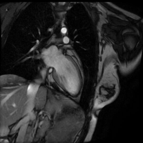 File:Arrhythmogenic right ventricular cardiomyopathy (Radiopaedia 87505-103850 2ch (LV) Cine SSFP 35).jpg