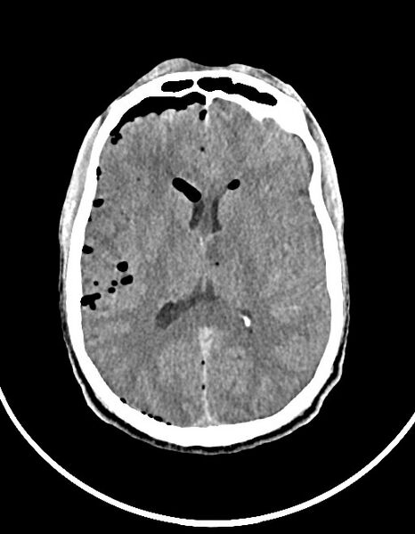 File:Arrow injury to the brain (Radiopaedia 72101-82607 Axial 51).jpg