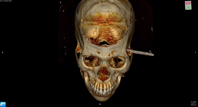File:Arrow injury to the head (Radiopaedia 75266-86388 3D vertical 11).jpg