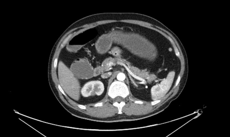 File:Arterial occlusive mesenteric ischemia (Radiopaedia 84641-100060 A 48).jpg