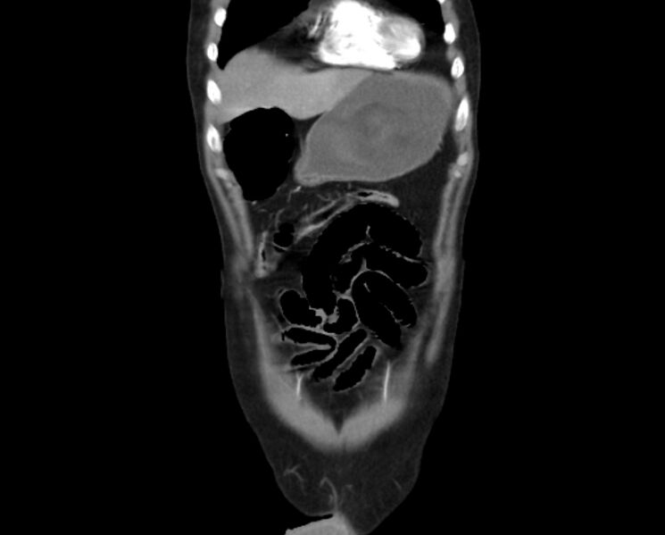 File:Arterial occlusive mesenteric ischemia (Radiopaedia 84641-100060 B 9).jpg