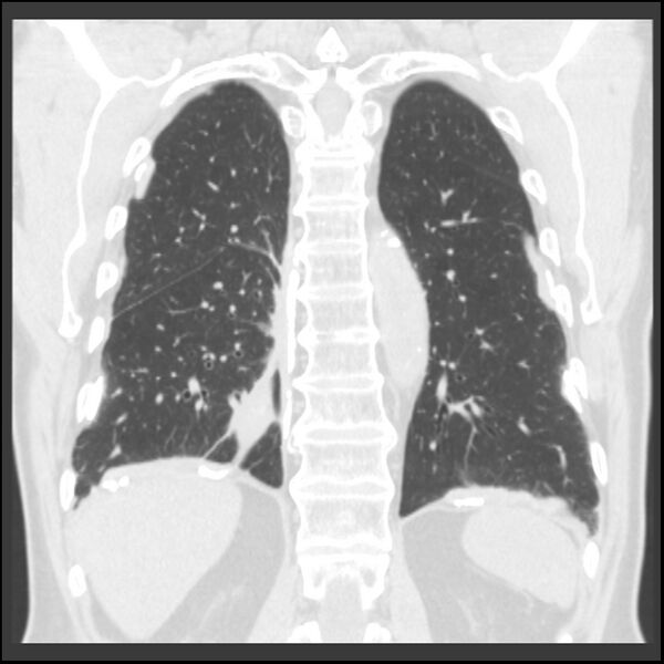 File:Asbestos-related pleural plaques (Radiopaedia 39069-41255 Coronal lung window 23).jpg