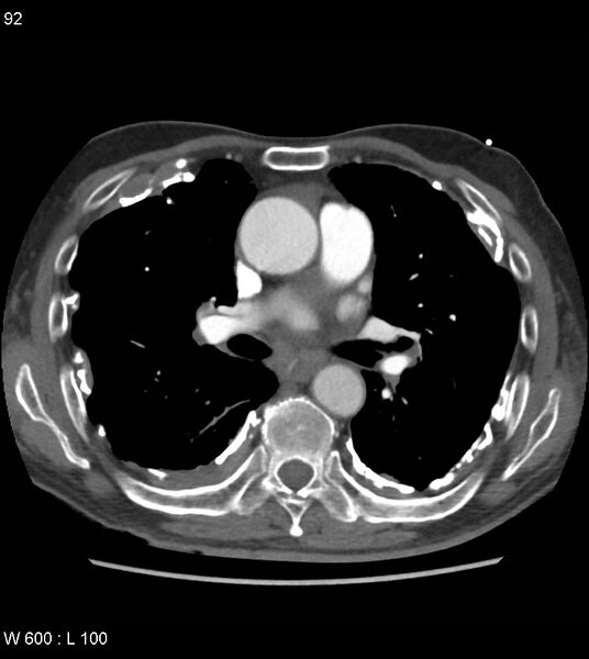 File:Asbestos related lung and pleural disease (Radiopaedia 14377-14301 D 28).jpg