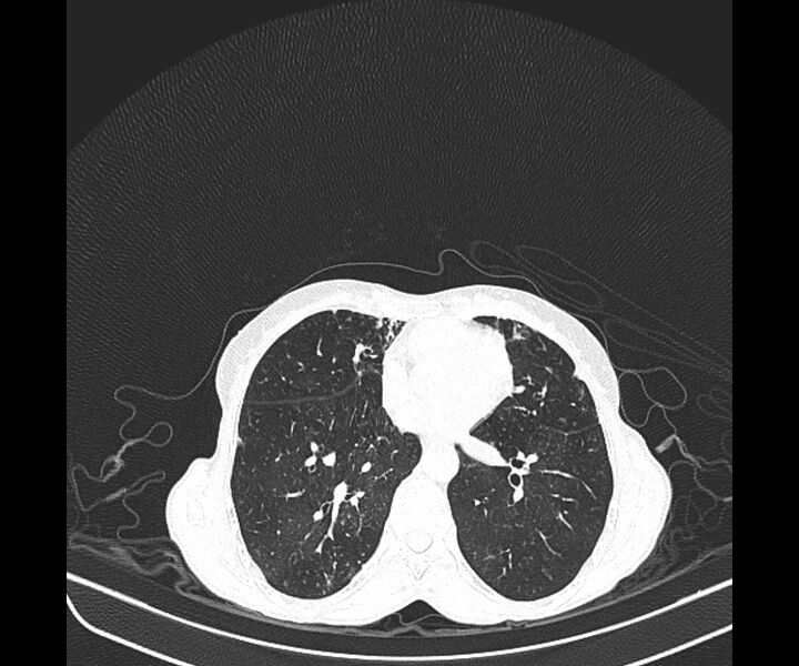File:Aspergillomas (Radiopaedia 66779-76110 Axial lung window 29).jpg