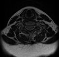 Astrocytoma - spinal cord (Radiopaedia 69769-79758 Axial T2 15).jpg