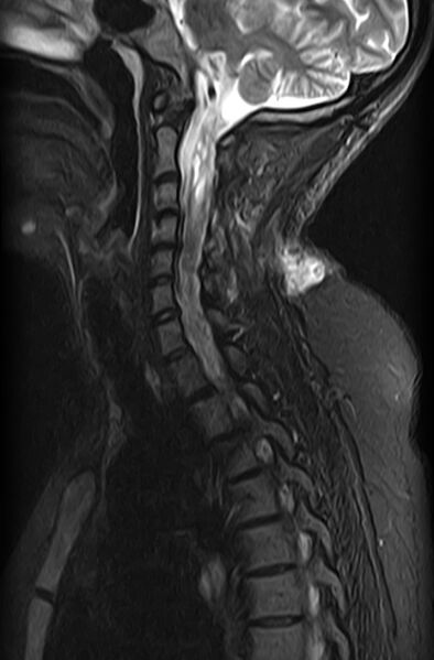 File:Astrocytoma - spinal cord (Radiopaedia 69769-79758 Sagittal STIR 5).jpg