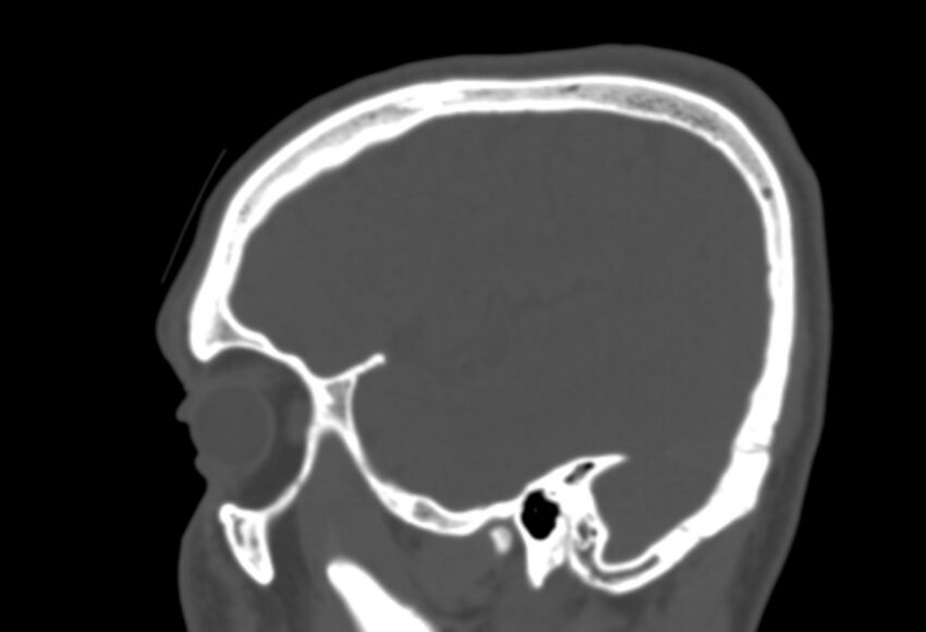 Asymptomatic occipital spur (Radiopaedia 87753-104201 Sagittal bone window 59).jpg