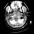 Atlanto-occipital dislocation (Radiopaedia 44648-48412 Axial non-contrast 5).jpg