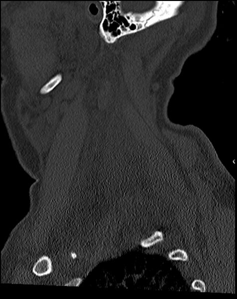 File:Atlanto-occipital dissociation - Traynelis type 1 (Radiopaedia 87570-103948 Sagittal bone window 69).jpg